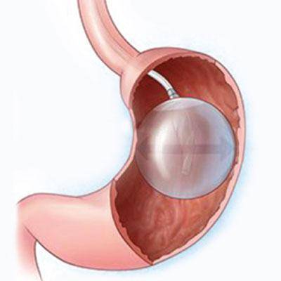 Gastric balloon faq