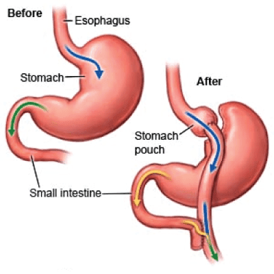 bypass gastric faq