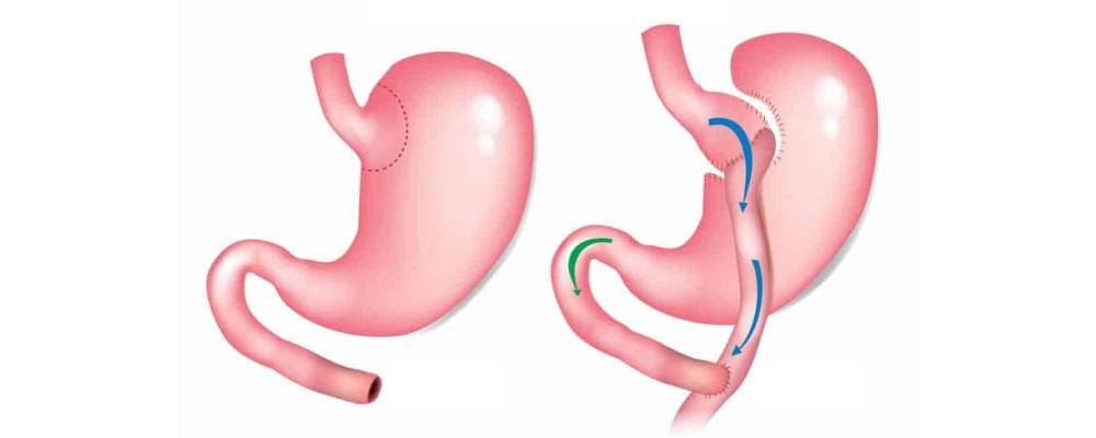 Gastric Bypass