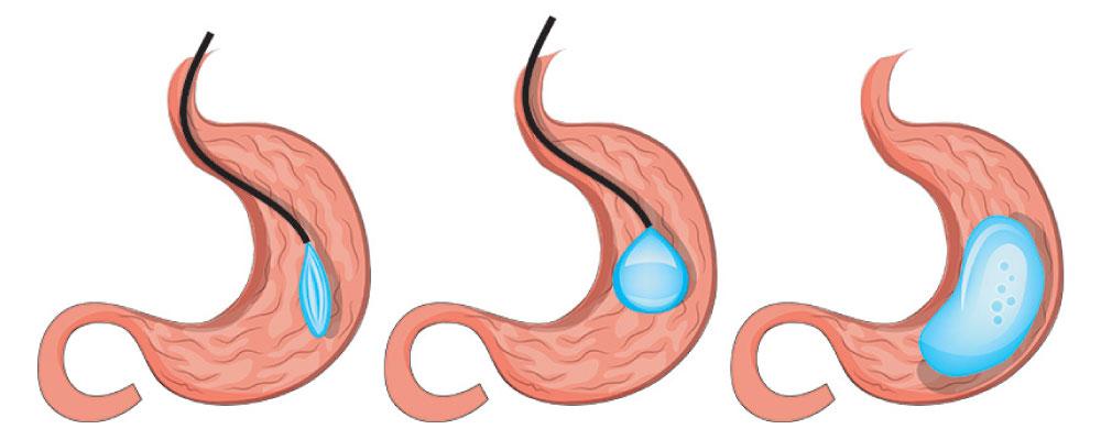 Gastric Balloon