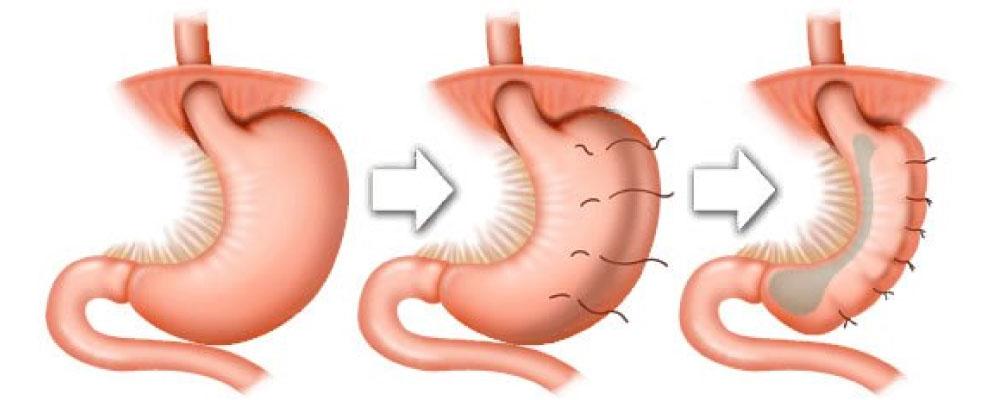 Endoscopic Sleeve Gastroplasty (ESG)