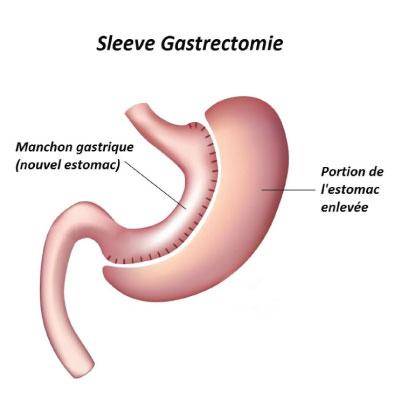 sleeve gastrectomy faq