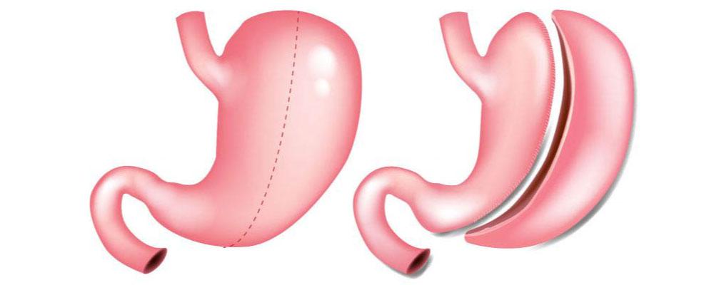 Sleeve Gastrectomy