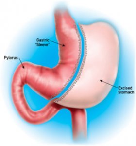 Edit Column Edit Heading Impact of sleeve gastrectomy :weight loss & health outcomes