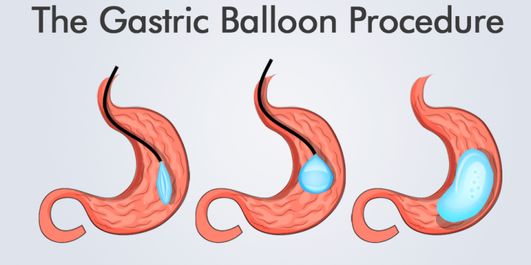 Understanding Gastric Balloons: A Comprehensive Guide to Non-Surgical Weight Loss