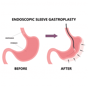 A Patient's Guide to Endoscopic Sleeve Gastroplasty