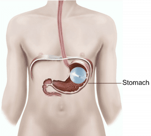 Understanding Gastric Balloons: A Comprehensive Guide to Non-Surgical Weight Loss