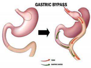 Navigating Life After Gastric Bypass Surgery: Tips for Success