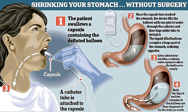 The Gastric Balloon: A Revolutionary Approach to Weight Loss