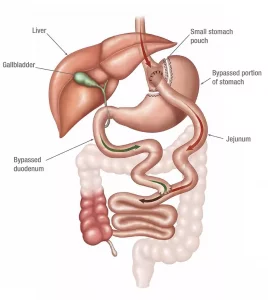 How to Determine if Gastric Bypass Surgery is Right for You