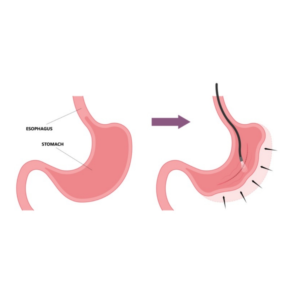 Endoscopic Sleeve Gastroplasty